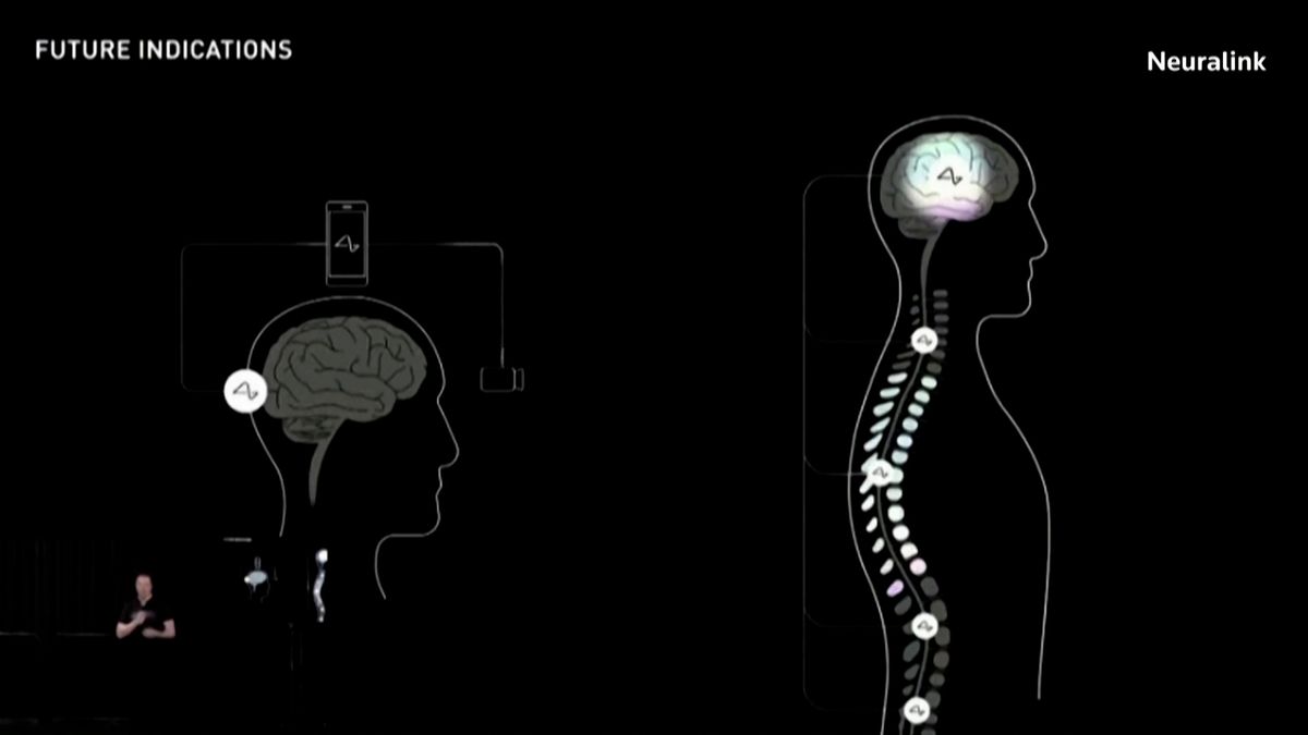 Musk: První pacient s naším mozkovým čipem dokáže ovládat myš pouhými myšlenkami